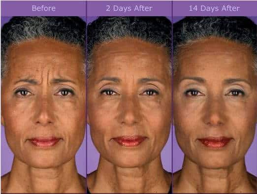 Botox Results graphic